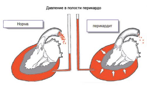1403102489_perikardit